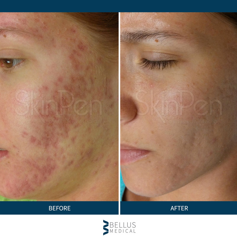 before and after image of benefits of microneedling with SkinPen of