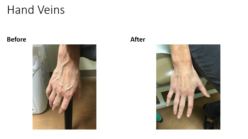 Hand Vein Treatment in Denver Medical Spa