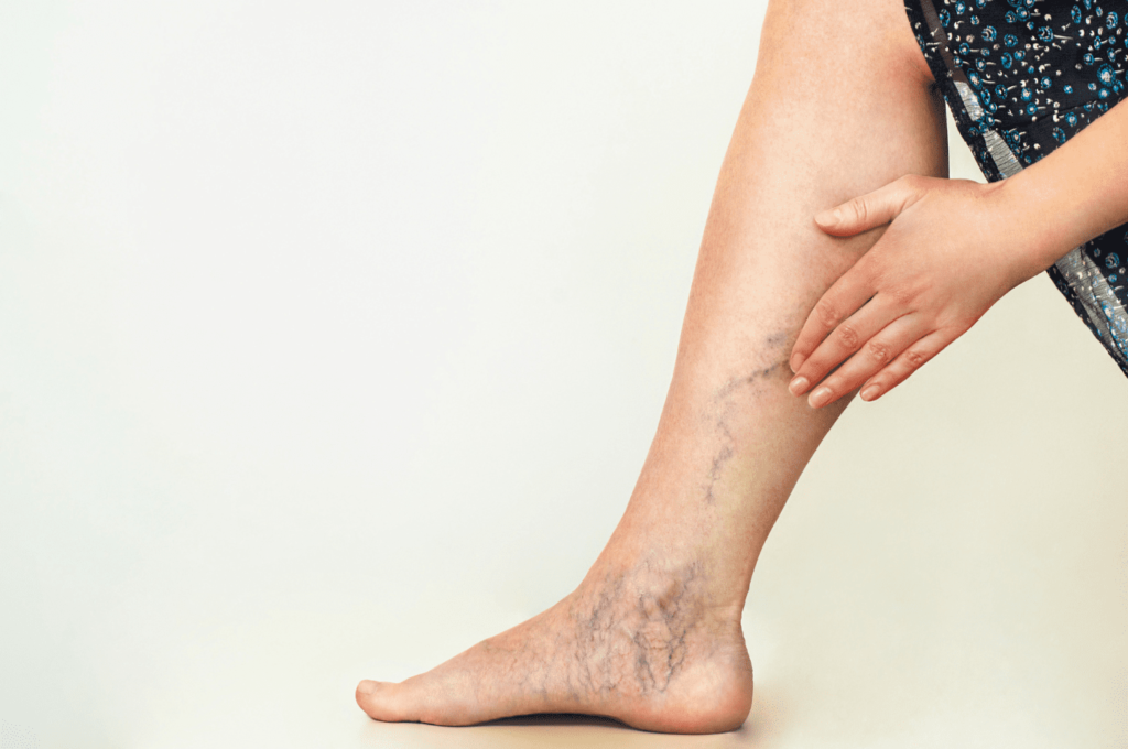vein removal with sclerotherapy in denver