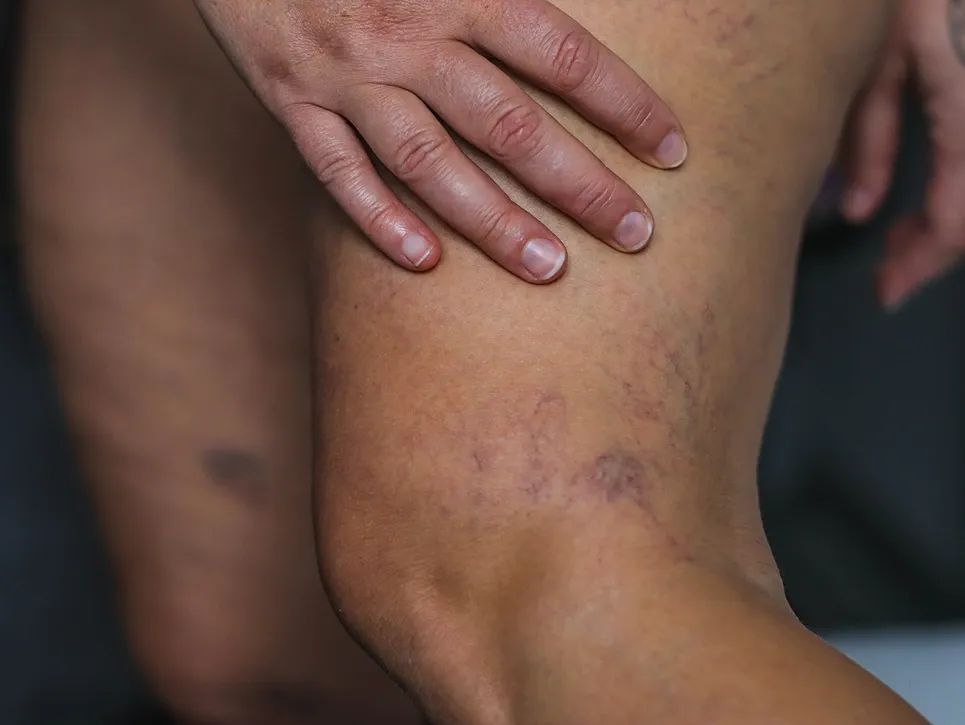 does-those-blue-light-at-home-devices-work-for-spider-veins1 How Healthy Veins Unlock Better Blood Flow and Vitality