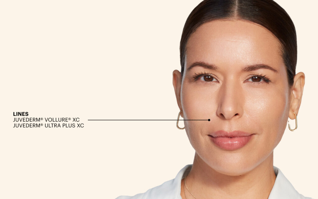 Patient receiving a Juvederm injection at Evexias Medical Spa in Englewood for natural facial rejuvenation.