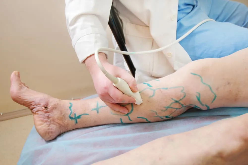 How Sclerotherapy Fits Into a Full-Leg Makeover Strategy